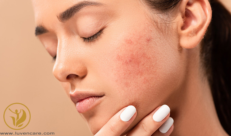 قرمزی صورت مربوط به اگزما