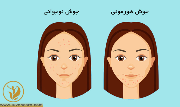 تفاوت جوش هورمونی و جوش نوجوانی