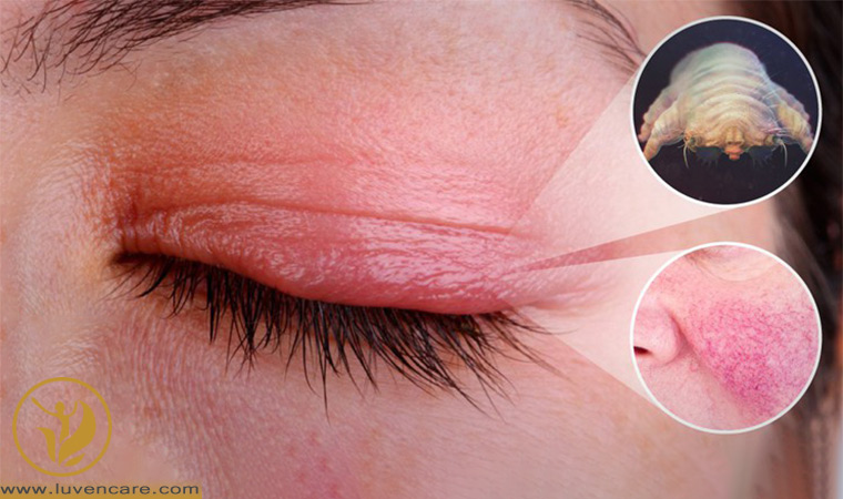 ارتباط انگل دمودکس با التهاب پلک یا بلفاریت