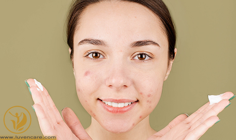 محصولات موضعی برای درمان جوش صورت