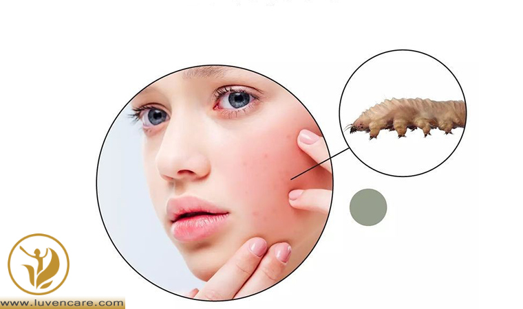 درمان تراکم بالای انگل دمودکس