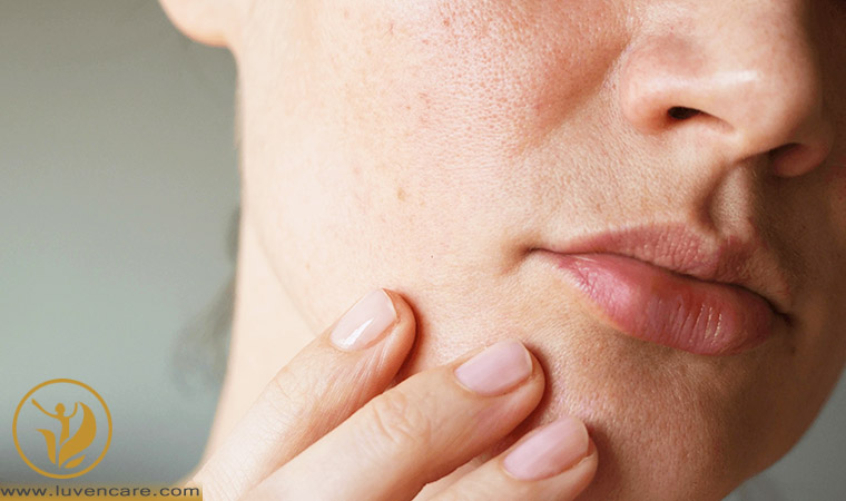 ویژگی های پوست خشک