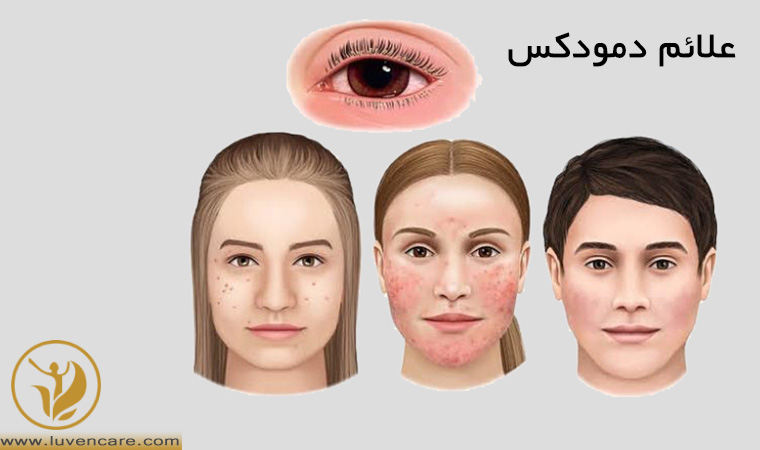 نشانه های انگل دمودکس