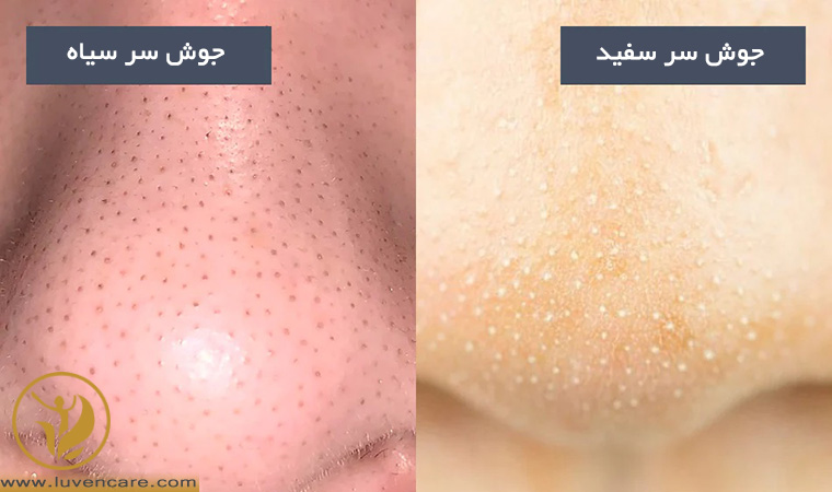 جوش سر سفید