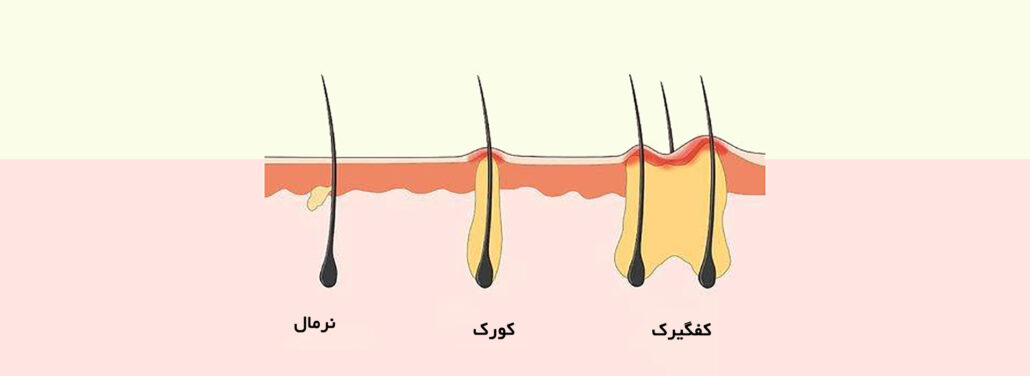 کورک چیست