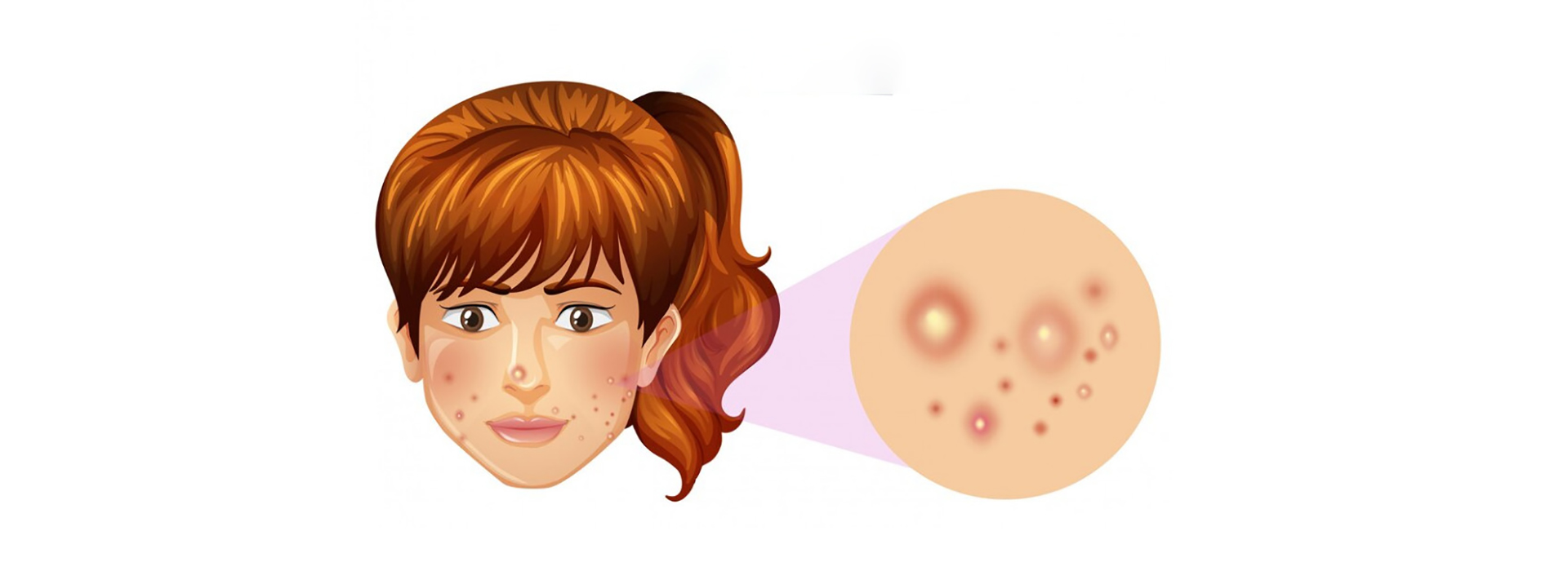 علت ایجاد جوش سرسفید روی صورت علت ایجاد جوش سرسفید روی صورت