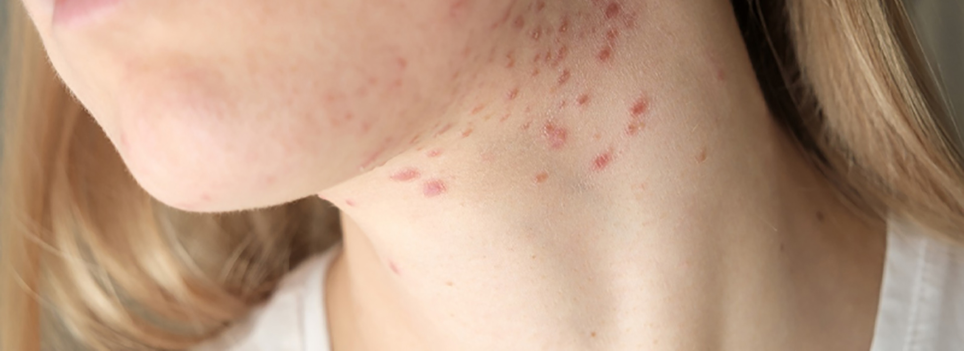 علت جوش گردن علت جوش گردن